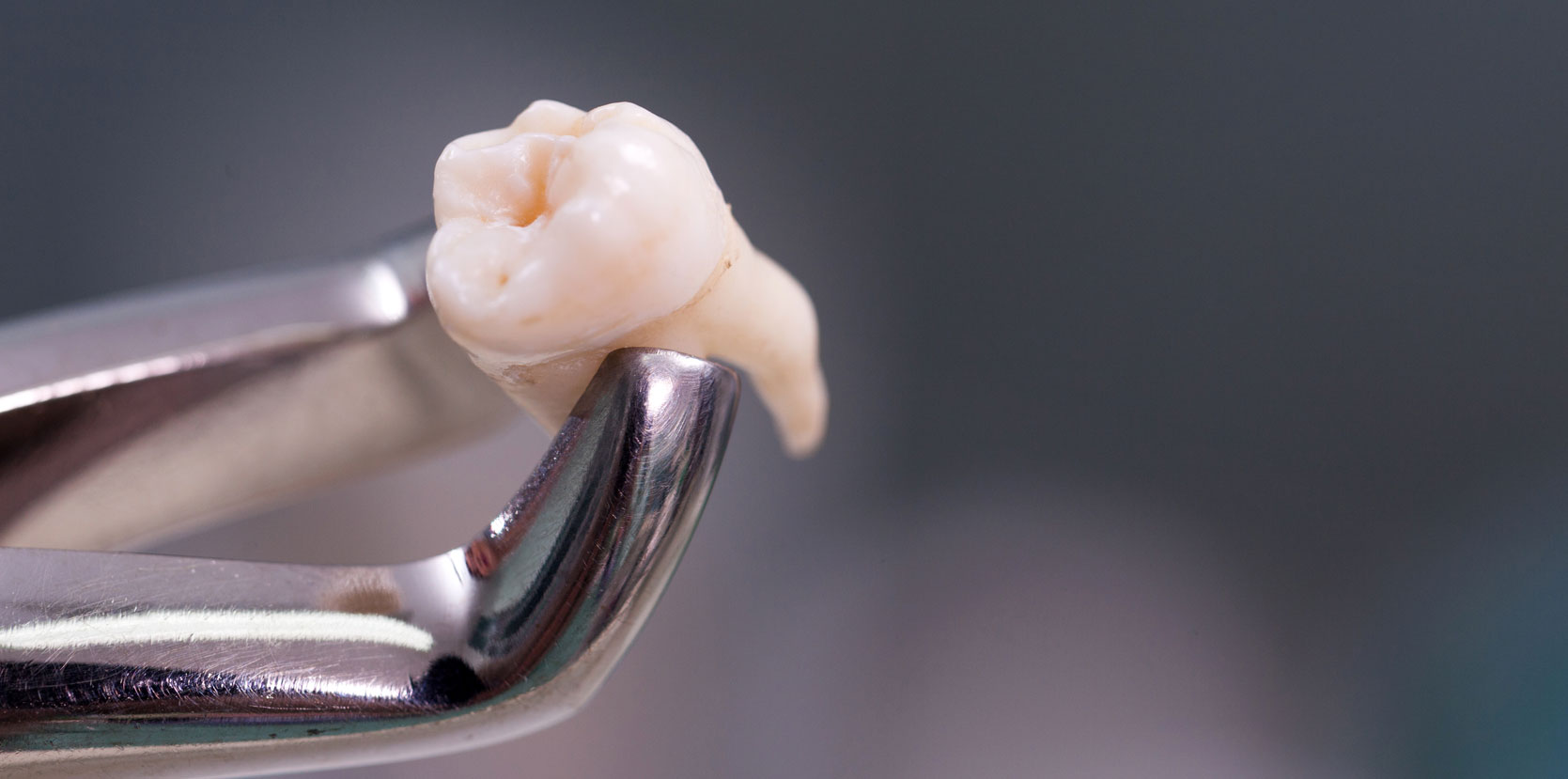 Tooth Extraction Hixson, TN